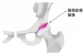 股関節唇損傷とは 股関節の痛み 関内の股関節痛を専門とする整体院